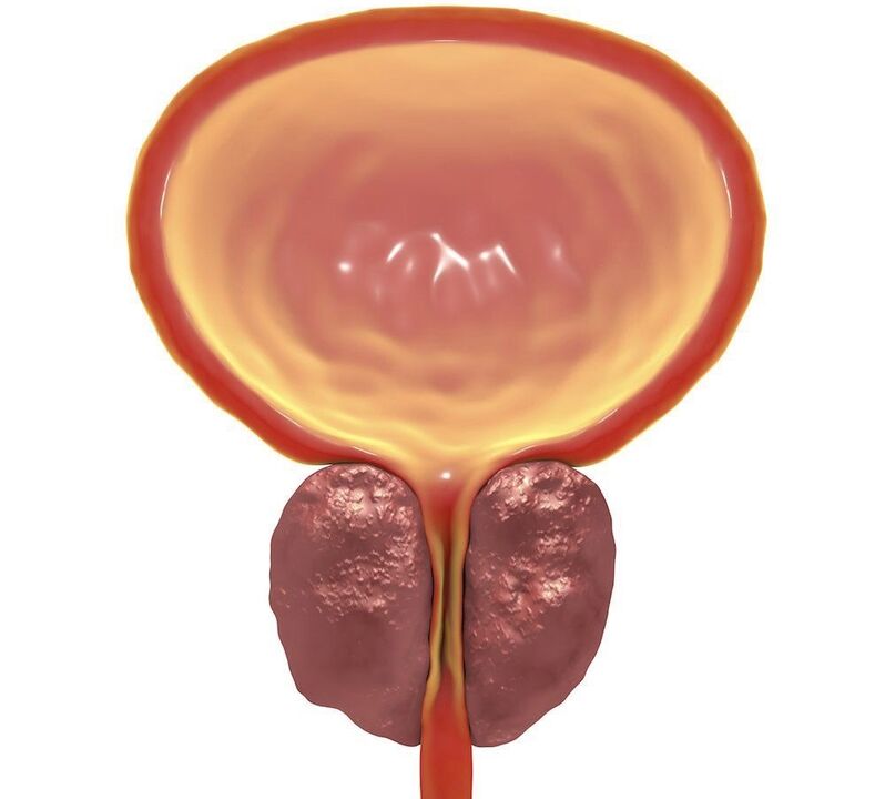 Entzündung vun chronescher Prostatitis