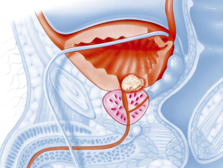 Symptomer vun chronescher Prostatitis